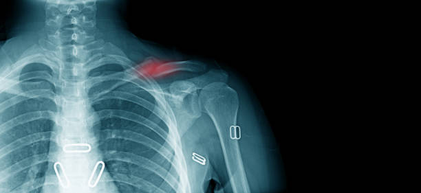 Clavicle Fractures